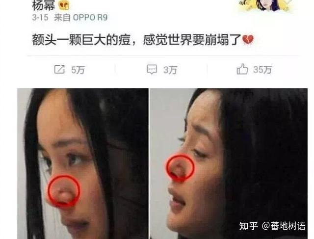 明星痘痘現象，時代下的影響與觀察